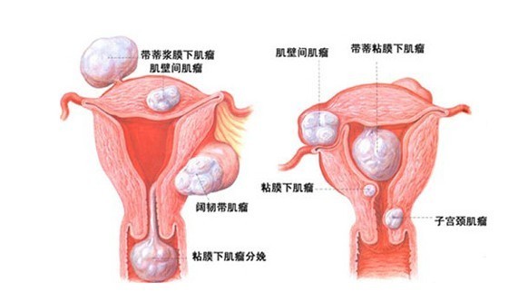 子宫肌多大需要手术